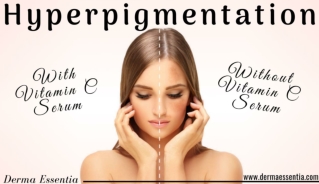 Hyperpigmentation Cure with Vitamin C Serum