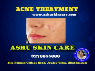 Ashu skin care is best for acne treatment clinic in bhubaneswar, odisha.