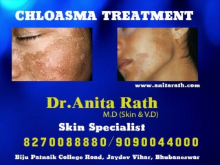 Ashu skin care is best skin specialist for cholasma treatment in bhubaneswar, odisha.