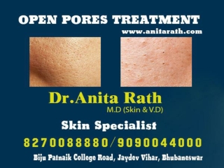Ashu skin care is best for open pores treatment clinic in bhubaneswar,odisha.