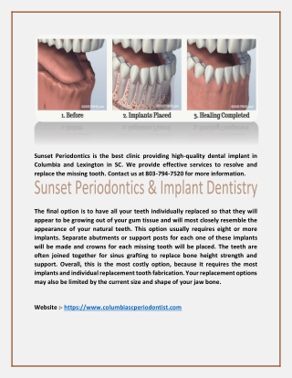 Dental Implants Columbia SC_columbiascperiodontist.com