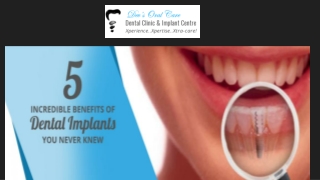 5 Incredible Benefits of Dental Implants You Never Knew