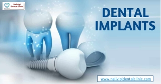 Best Dental Implants Clinics in Bellandur | Best Dentists in Bellandur| Nelivigi Dental Clinic