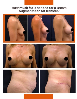 How much fat is needed for a Breast Augmentation fat transfer?