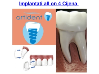 Implantati all on 4 cijena