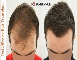 Cost Effective Hair Transplant