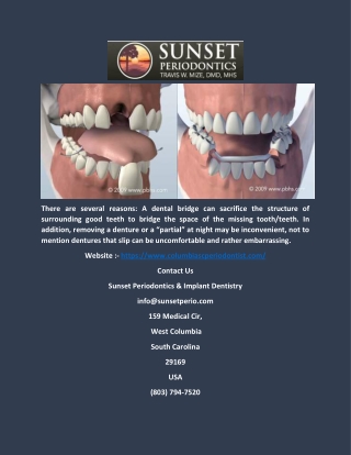 Dental Implant in Columbia, Lexington, SC_columbiascperiodontist.com