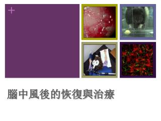 腦中風 後 的 恢復與治療