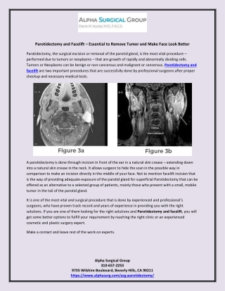 Parotidectomy and Facelift – Essential to Remove Tumor and Make Face Look Better