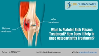 What Is Platelet-Rich Plasma Treatment? How Does It Help in Knee Osteoarthritis Treatment? | Dr Chirag Patel