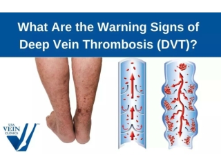 The Most Common Warning Signs of DVT - USA Veins Clinics