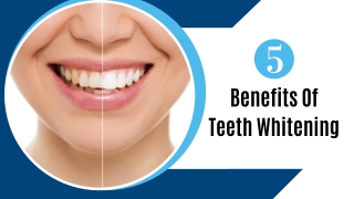 5 Benefits Of Teeth Whitening