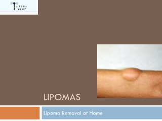 Get a Natural Lipoma Treatment at Home