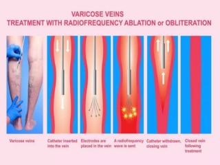Varicose Veins: A Common Affliction