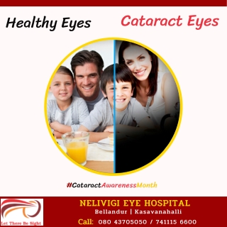 Cataract Eyes | Best Eye Clinics Near Me | Best Eye hospitals Near Me in Bangalore | Nelivigi Eye