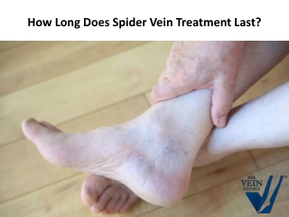 How Long Does Spider Vein Treatment Last?