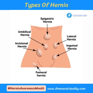 Types Of Hernia - Laparoscopic Hernia Surgery Near Me in Bangalore, HSR Layout, Koramangala - Dr. Manas Tripathy