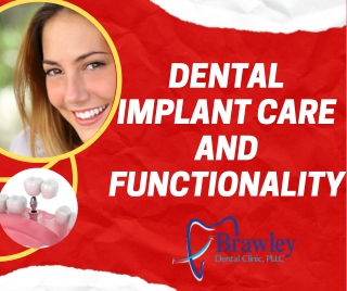 Dental Implant Care and Functionality