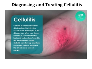 Diagnosing and Treating Cellulitis