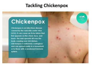 Tackling Chickenpox