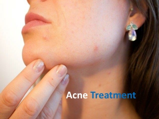 Expert Acne Dermatologist Near Me- Lansing, Mt. Pleasant