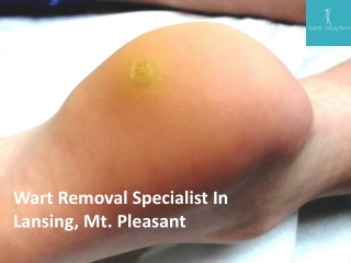 Wart Removal Specialist In Lansing and Mt. Pleasant