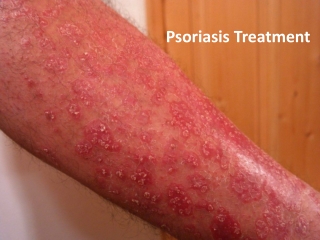 Psoriasis Specialist In Lansing and Mount Pleasant