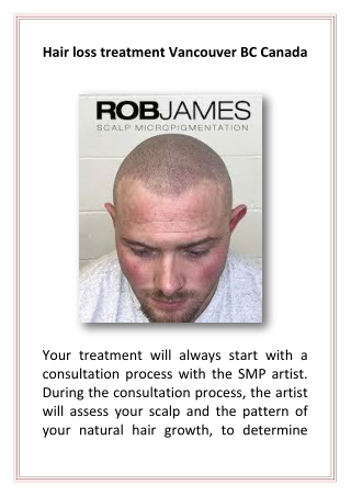 Hair loss treatment Vancouver BC Canada