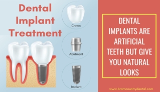 Dental Implant by Dentist Countryside Dr