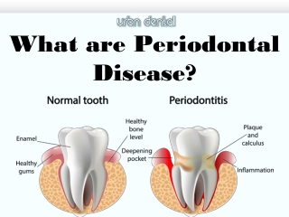 What are Periodontal Disease?