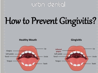 How to Prevent Gingivitis?